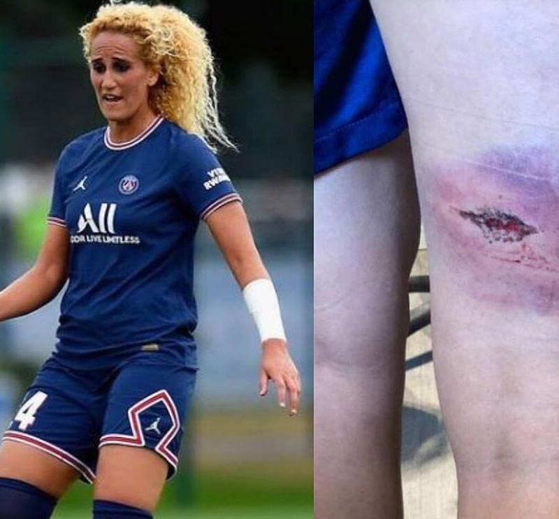 vết thương của nữ cầu thủ tuyển Pháp
