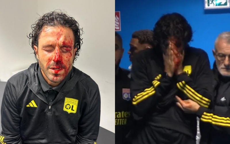 HLV trưởng Lyon - Fabio Grosso bị thương sau khi bị một mảng kính rơi trúng